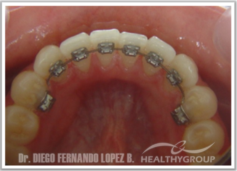 ortodoncia-lingual-5497.png